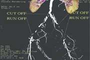 Diagnostic Accuracy of Sixty Four Multi-Slice CT Angiography in Assessment of Arterial Cut-Off and Run-Off in Comparison with Surgical Findings